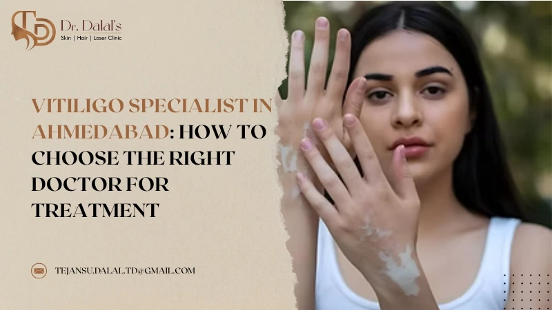 Vitiligo Specialist in Ahmedabad How to Choose the Right Doctor for Treatment