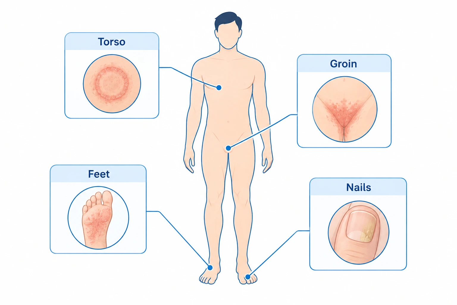 Diagram showing common body sites affected by different types of fungal skin infections