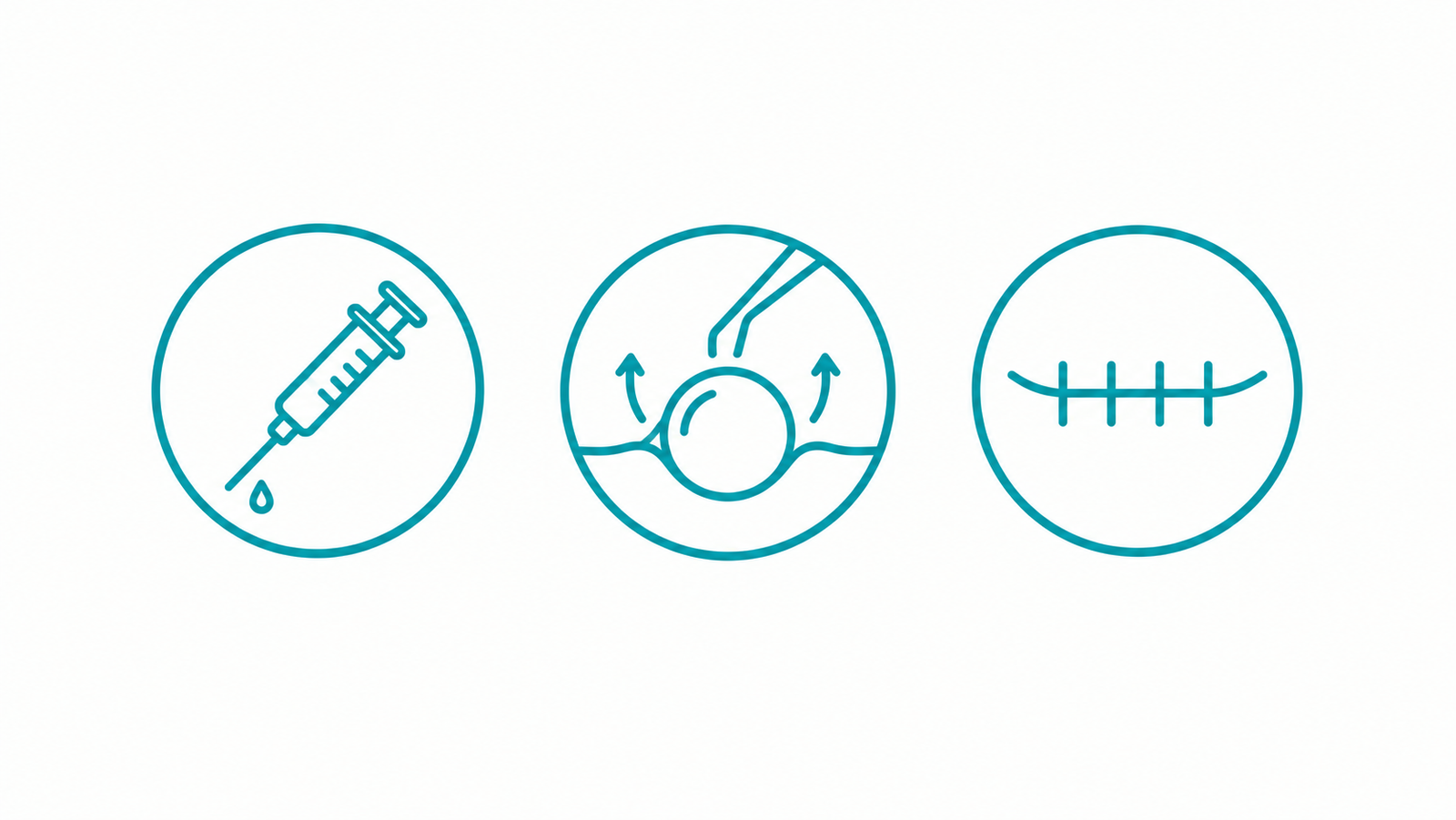 Icon row representing the main steps of a cyst removal procedure