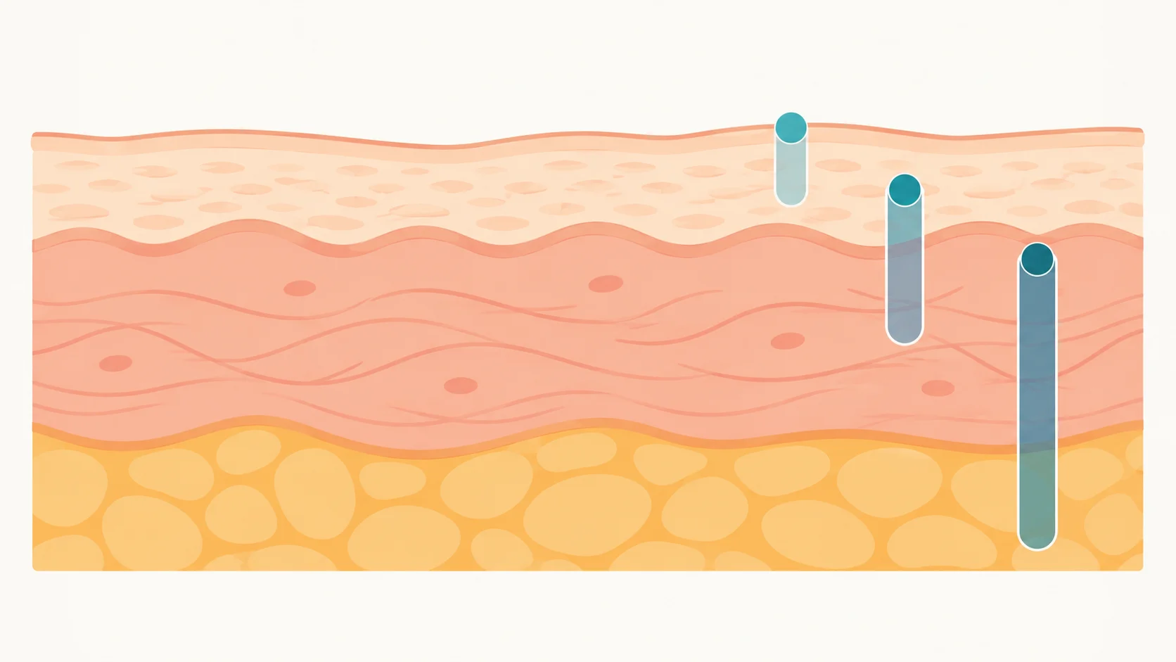 Illustration showing the three depth levels that chemical peels can reach in the skin