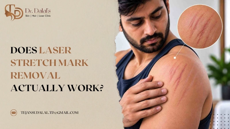 Illustration representing realistic results from laser stretch mark treatment